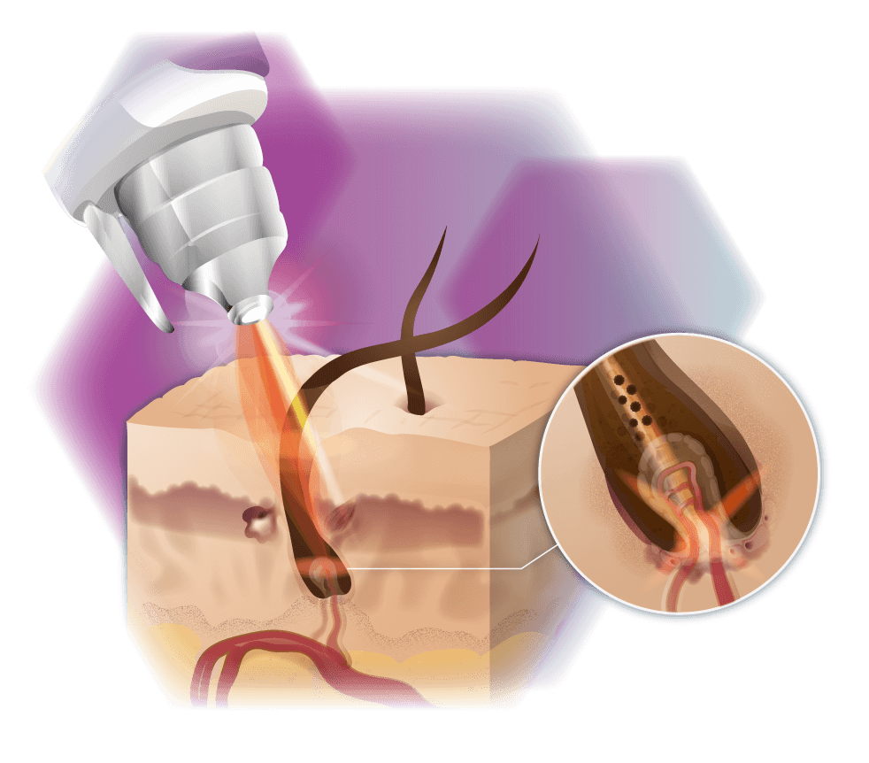 graphic mode of action illustration nd yag laser