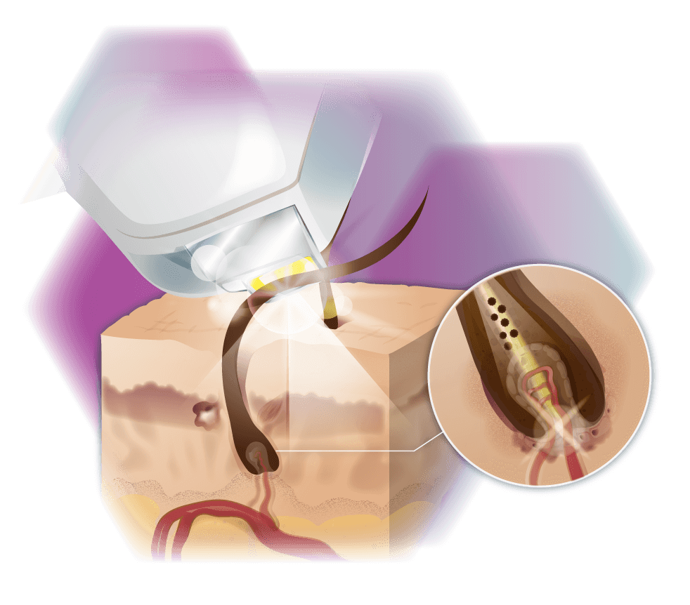 Graphic diode laser Effect of skin cross-section