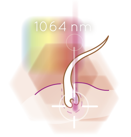 Illustration 1064 nm wave length nd yag laser