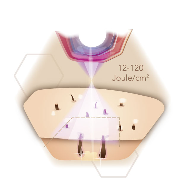 Infografik Wirkungsweise des Lichts auf die Haut bei der IPL-Haarentfernung