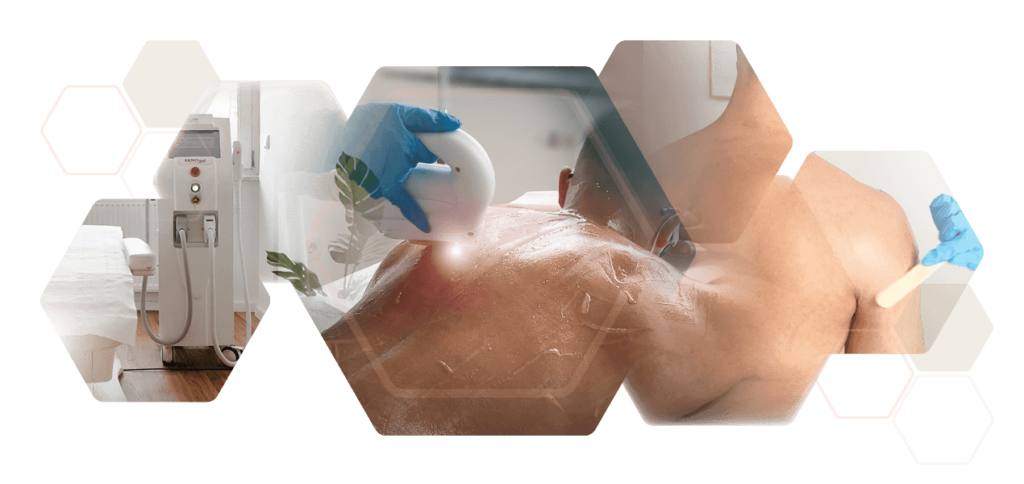 Photo set treatment man back and shoulders photoepilation care