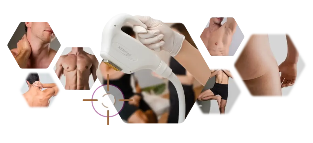 Kollage Körperregionen Behandlung dauerhafte Haarentfernung beim Mann